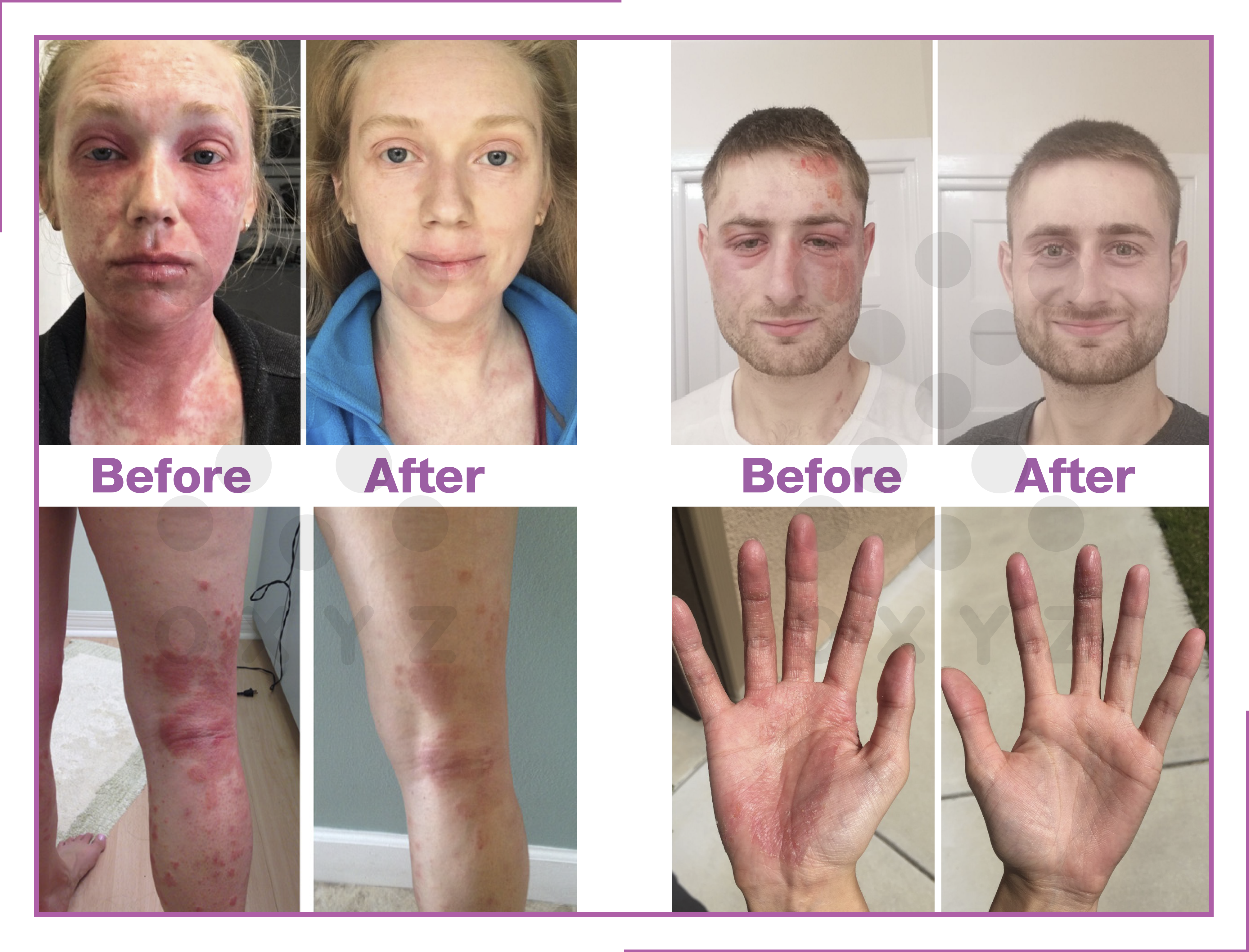 Eczema