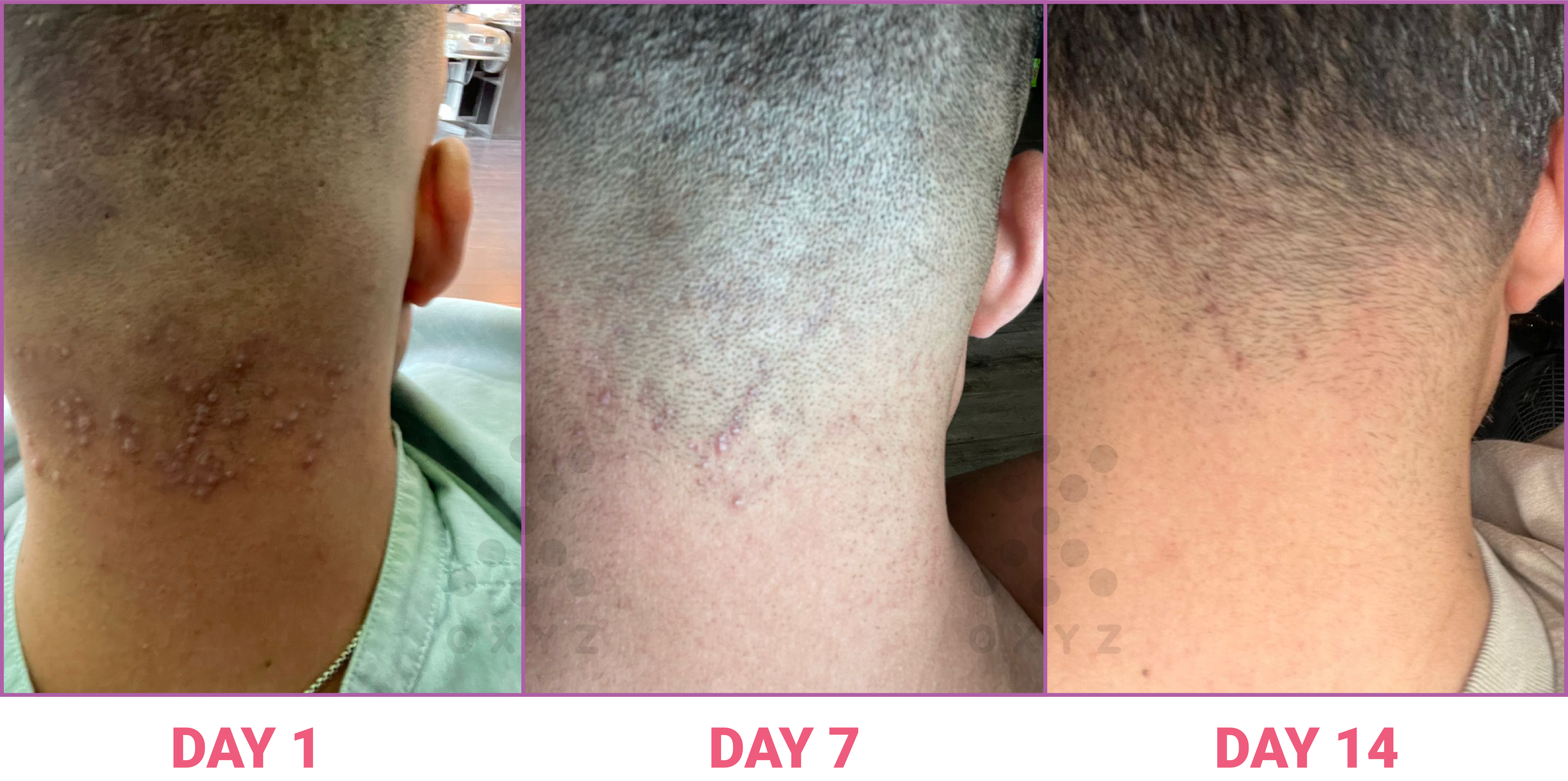 Skin Allergy