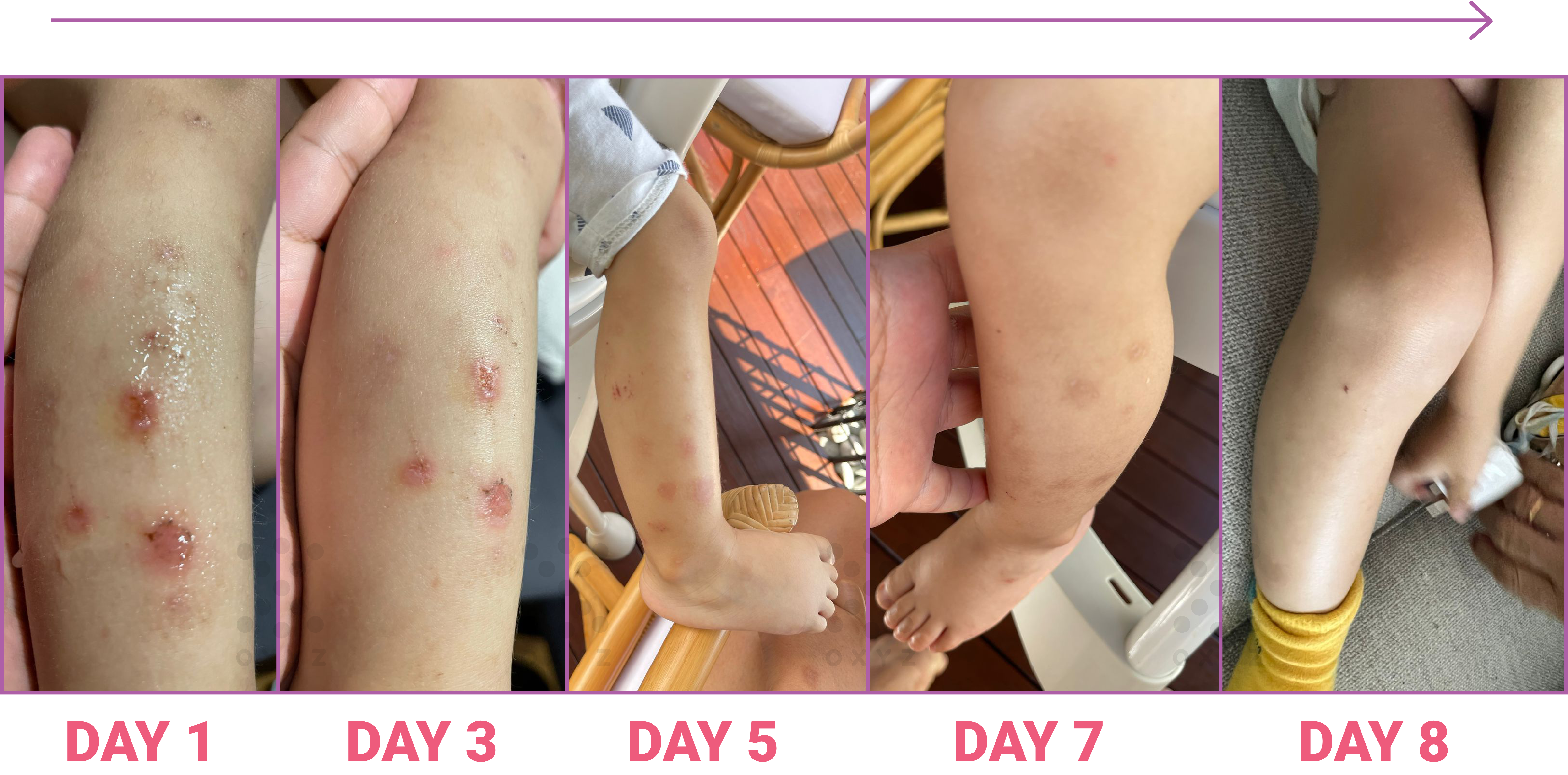 Eczema Treatment